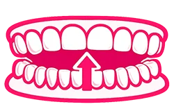 otvoreni zagriz pr sl1 4 1